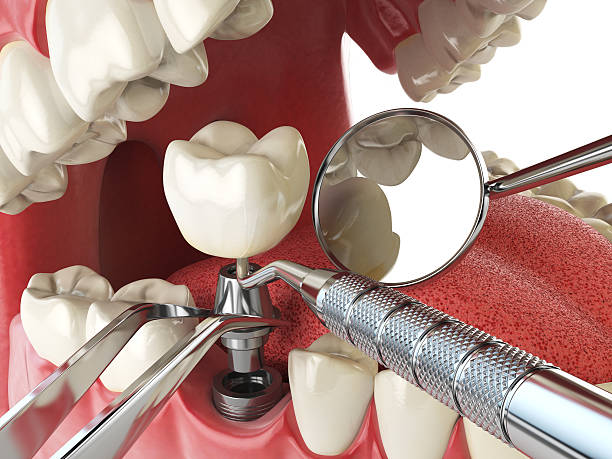 Best Emergency Tooth Extraction in Wesson, MS
